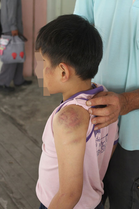 BRUISED: The father shows his son’s injuries. 