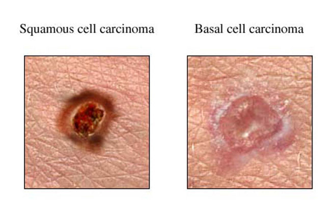 The two main types of NMSC are basal cell carcinoma and squamous cell carcinoma.