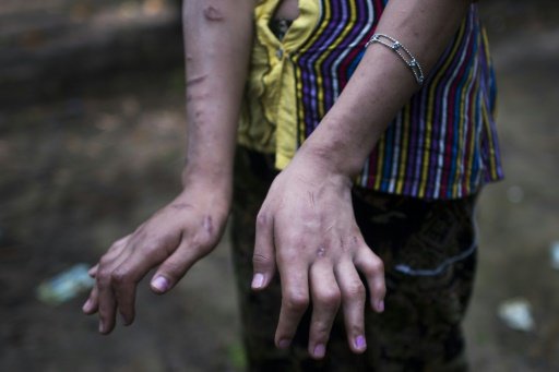 One of the girls showed fingers twisted at strange angles -- a cruel legacy, she says, of the punishments meted out to her. - AFP Photo