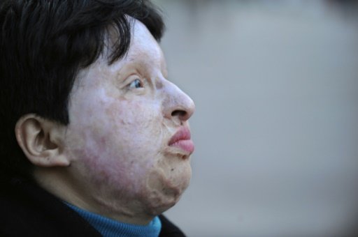 Ameneh Bahrami was blinded by a man who threw acid in her face -AFP photo