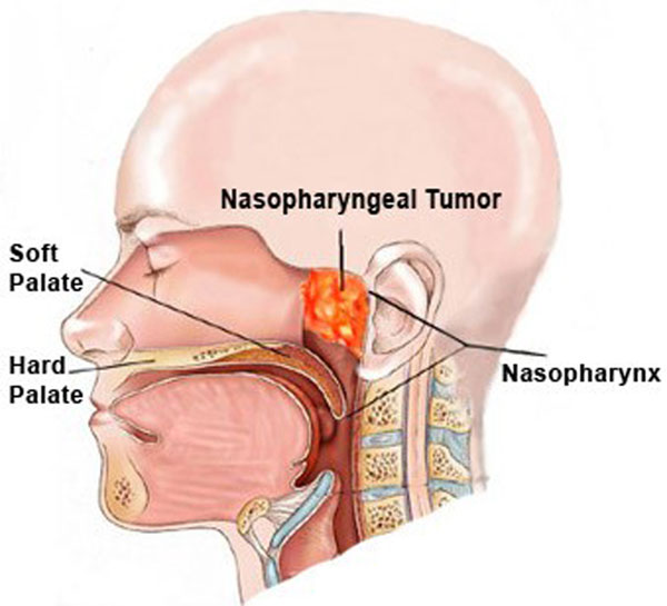Prognose van nasofarynxcarcinoom (overlevingspercentage)